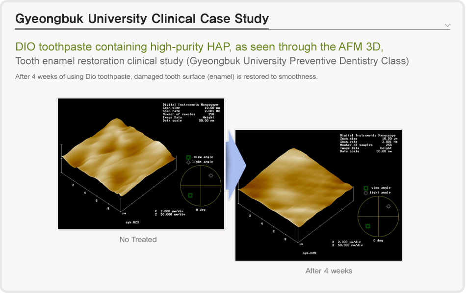  Gyeongbuk University Clinical Case Study: DIO toothpaste containing high-purity HAP, as seen through the AFM 3D,Tooth enamel restoration clinical study (Gyeongbuk University Preventive Dentistry Class After 4 weeks of using Dio toothpaste, damaged tooth surface (enamel) is restored to smoothness