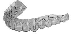 Digital Clear Aligner