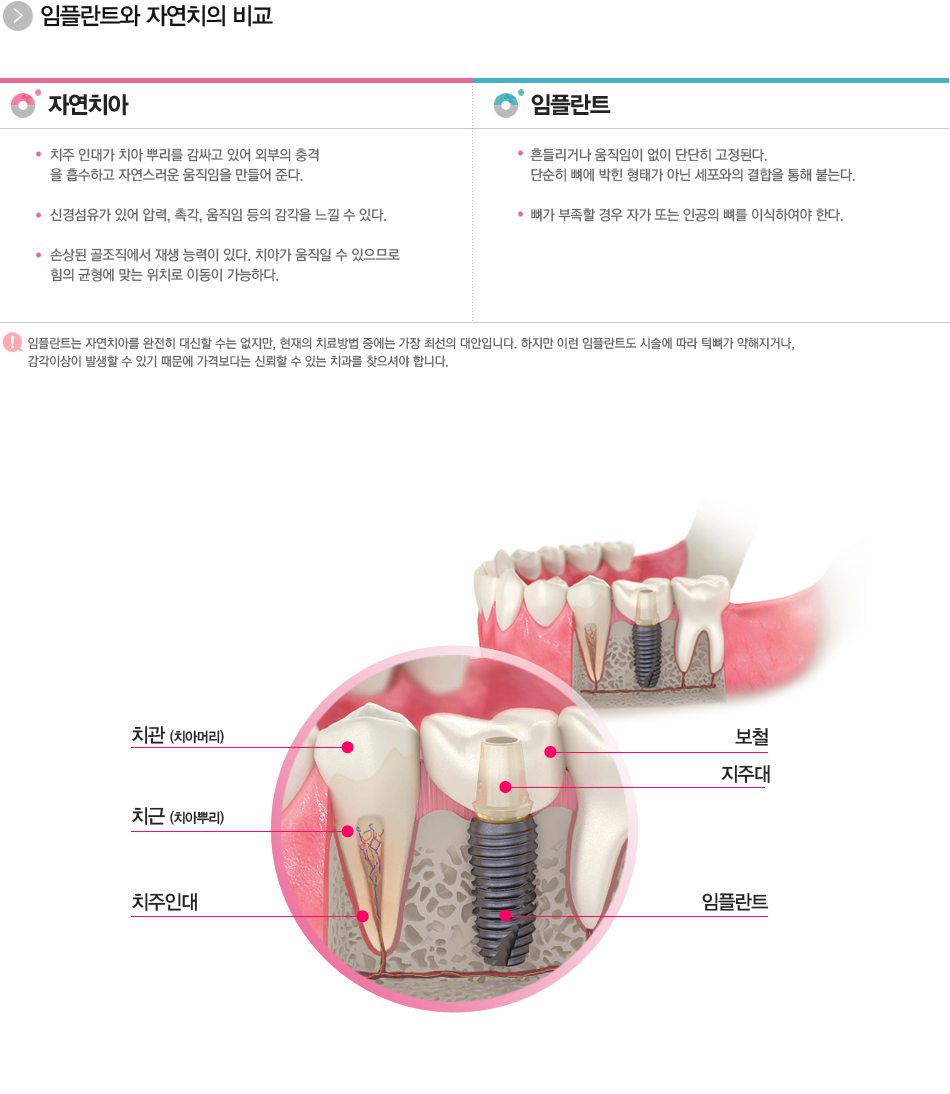 임플란트란