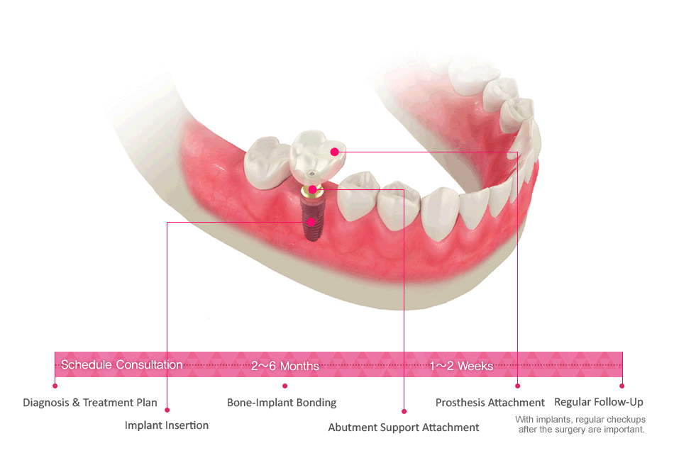 Diagnosis & Treatment Plan -> Implant Insertion -> Bone-Implant Bonding -> Abutment Support Attachment -> Prosthesis Attachment -> Regular Follow-Up (With implants, regular checkups 
after the surgery are important.)